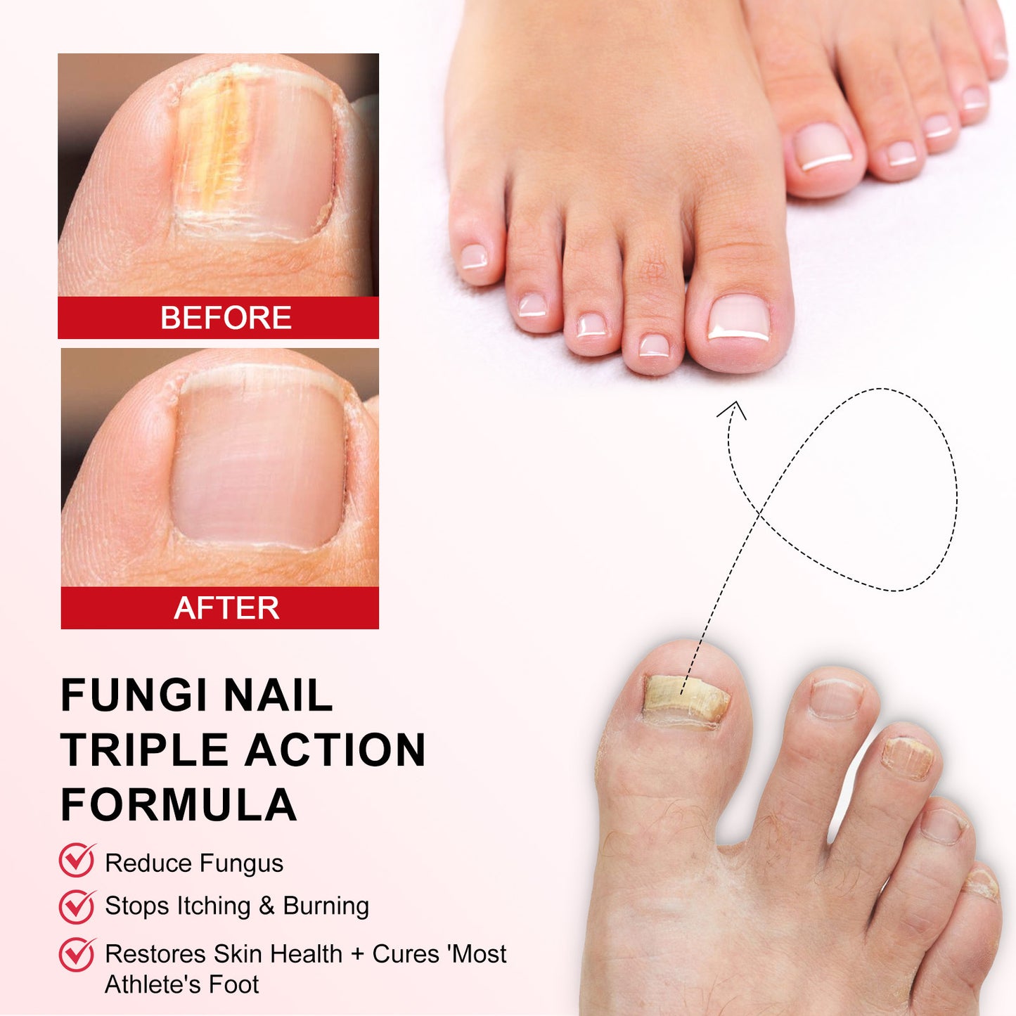 🦶✨ Restore the Look of Healthy Nails – Fast, Easy Daily Care with Special Effect Toenail Care Solution 💧-QO
