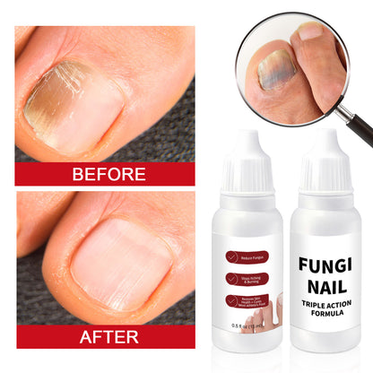 🦶✨ Restore the Look of Healthy Nails – Fast, Easy Daily Care with Special Effect Toenail Care Solution 💧-QO
