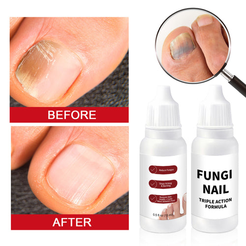 🦶✨ Restore the Look of Healthy Nails – Fast, Easy Daily Care with Special Effect Toenail Care Solution 💧-QO