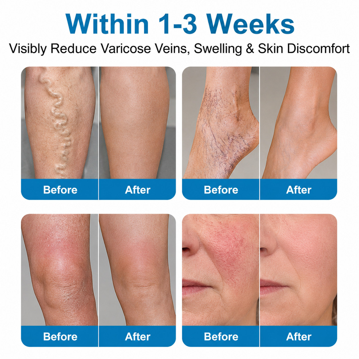 🇺🇸🏆✅️🏃VeinRepair Microneedle Patch Roll⚡Instant Relief, Long-Term Results-Q1