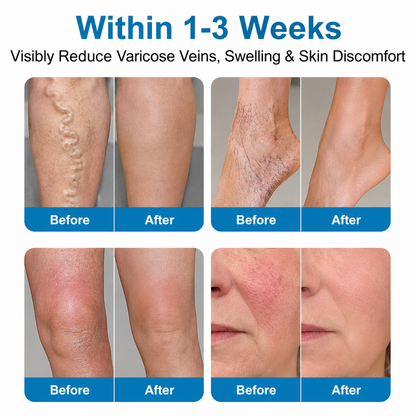 🇺🇸🏆✅️🏃VeinRepair Microneedle Patch Roll⚡Instant Relief, Long-Term Results-Q1