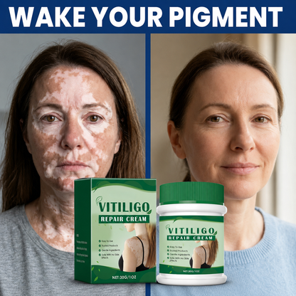 ✨ VITILIGO CARE CREAM | Helps Improve the Look of Uneven Skin Tone-QO
