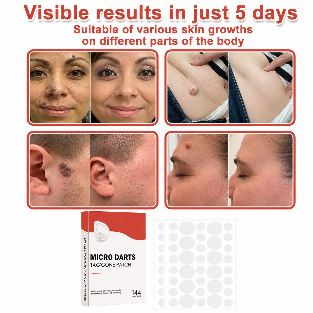 🚨 49% OFF TODAY ONLY MICRODARTS™ TAG'GONE PATCH ✨ 2-in-1 Microdart + Hydrocolloid Technology  ✨ Invisible Wear， Overnight Care，Face & Body-QO