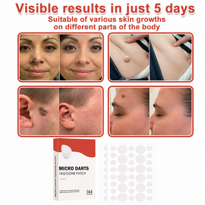🚨 49% OFF TODAY ONLY MICRODARTS™ TAG'GONE PATCH ✨ 2-in-1 Microdart + Hydrocolloid Technology  ✨ Invisible Wear， Overnight Care，Face & Body-QO
