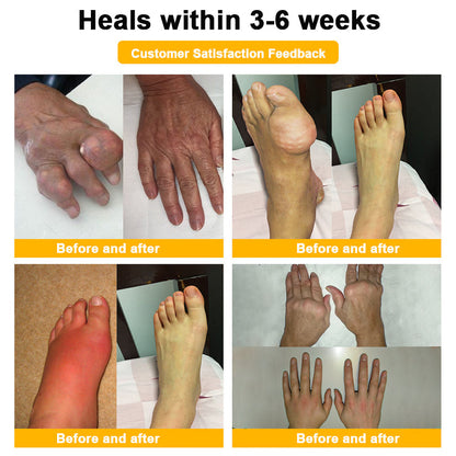 Botulinum Toxin & Bee Venom Pain-Relief Bone Healing Cream -QO