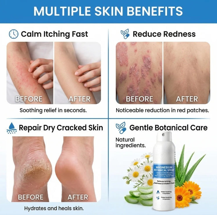 🔥Magnesium Botanical Spray – Advanced Skin Recovery for Psoriasis & Eczema | Rapid Soothing-FX