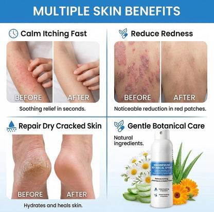 🔥Magnesium Botanical Spray – Advanced Skin Recovery for Psoriasis & Eczema | Rapid Soothing-FX