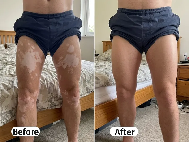 Before and After comparison